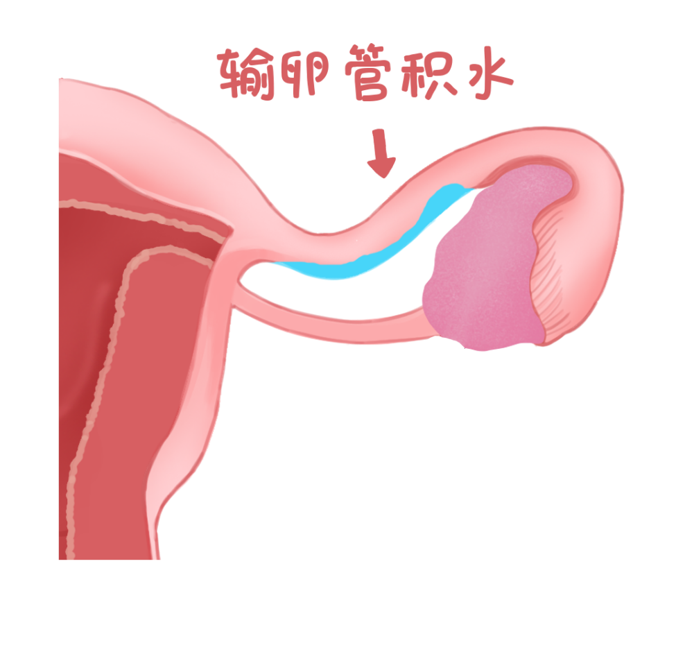输卵管堵塞是在贵州采取一般治疗还是直接做试管婴儿?