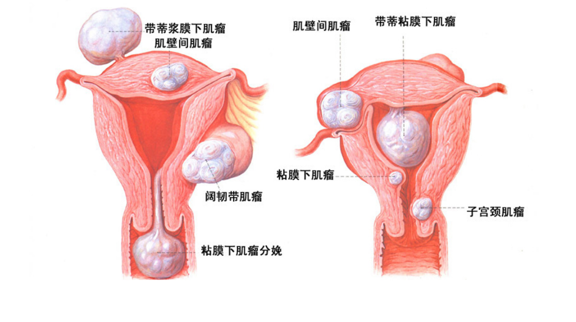有子宫肌瘤还能做试管婴儿吗？武汉董丽萍医生权威解答！